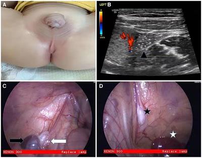 Splenogonadal fusion: a case report of three cases and a literature review